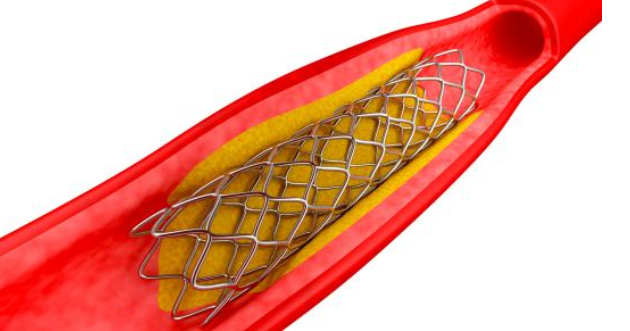 低溫黄瓜视频污污污在线观看技術對心血管支架藥物塗層均勻性和牢固度提升-黄瓜视频下载APP视频黄瓜视频污在线观看機