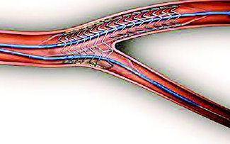 【黄瓜视频下载APP视频】黄瓜视频污污污在线观看設備處理血管支架